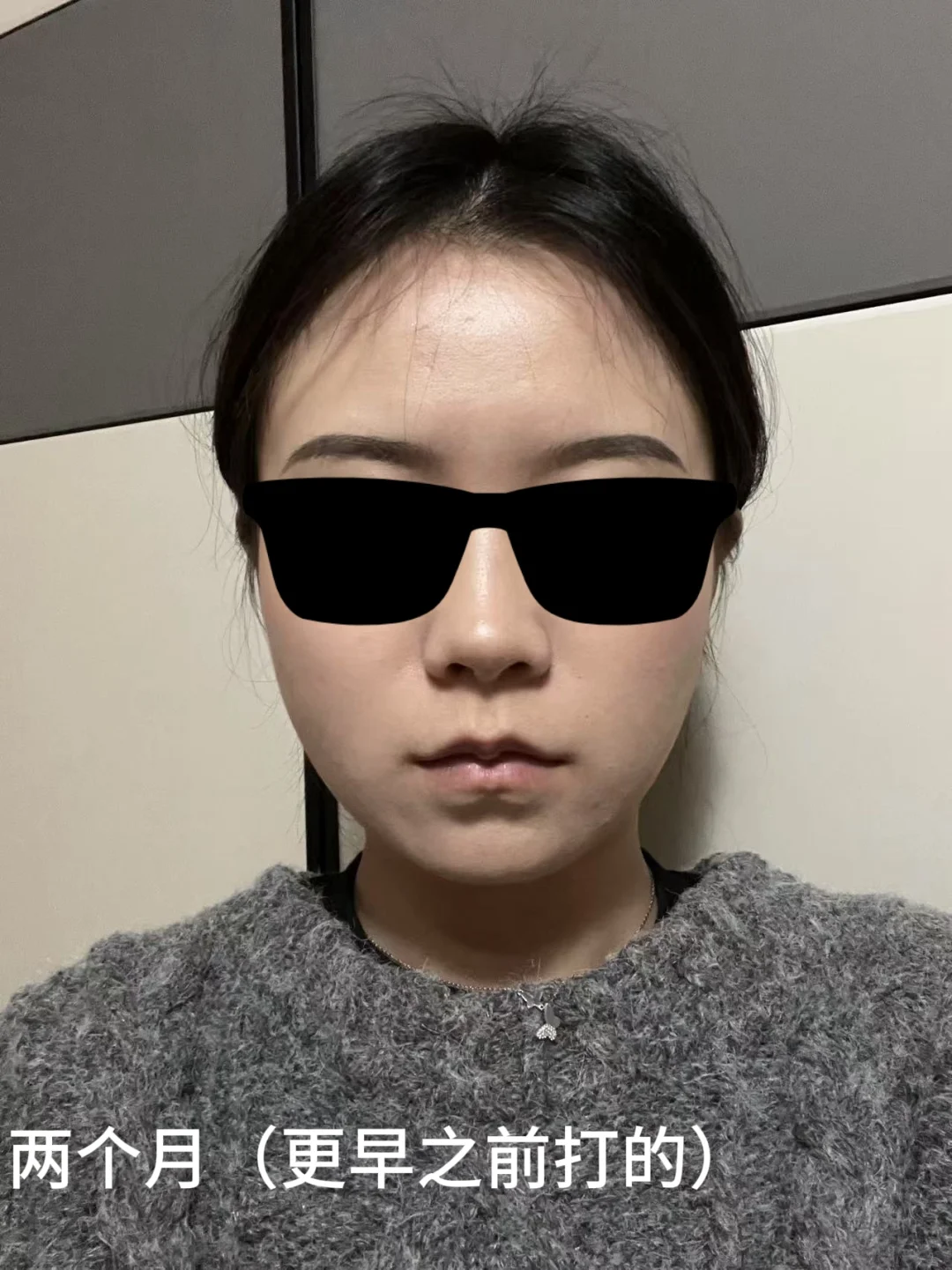 方圆脸瘦脸针一个月！