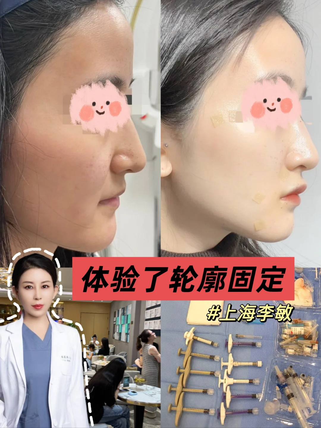30+宝妈上海抗衰！做了轮廓固定