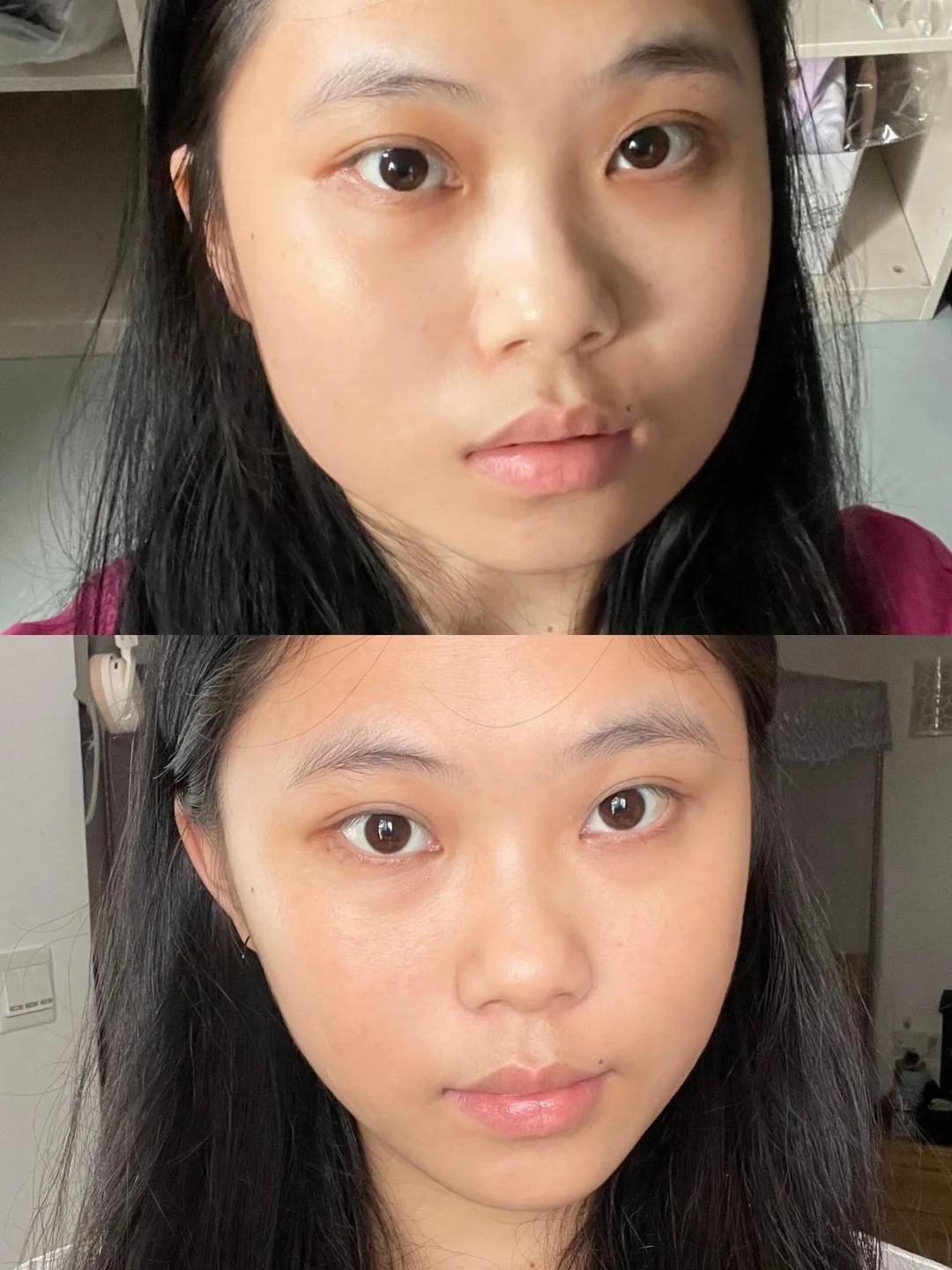 打了瘦脸针瘦咬肌两个月了