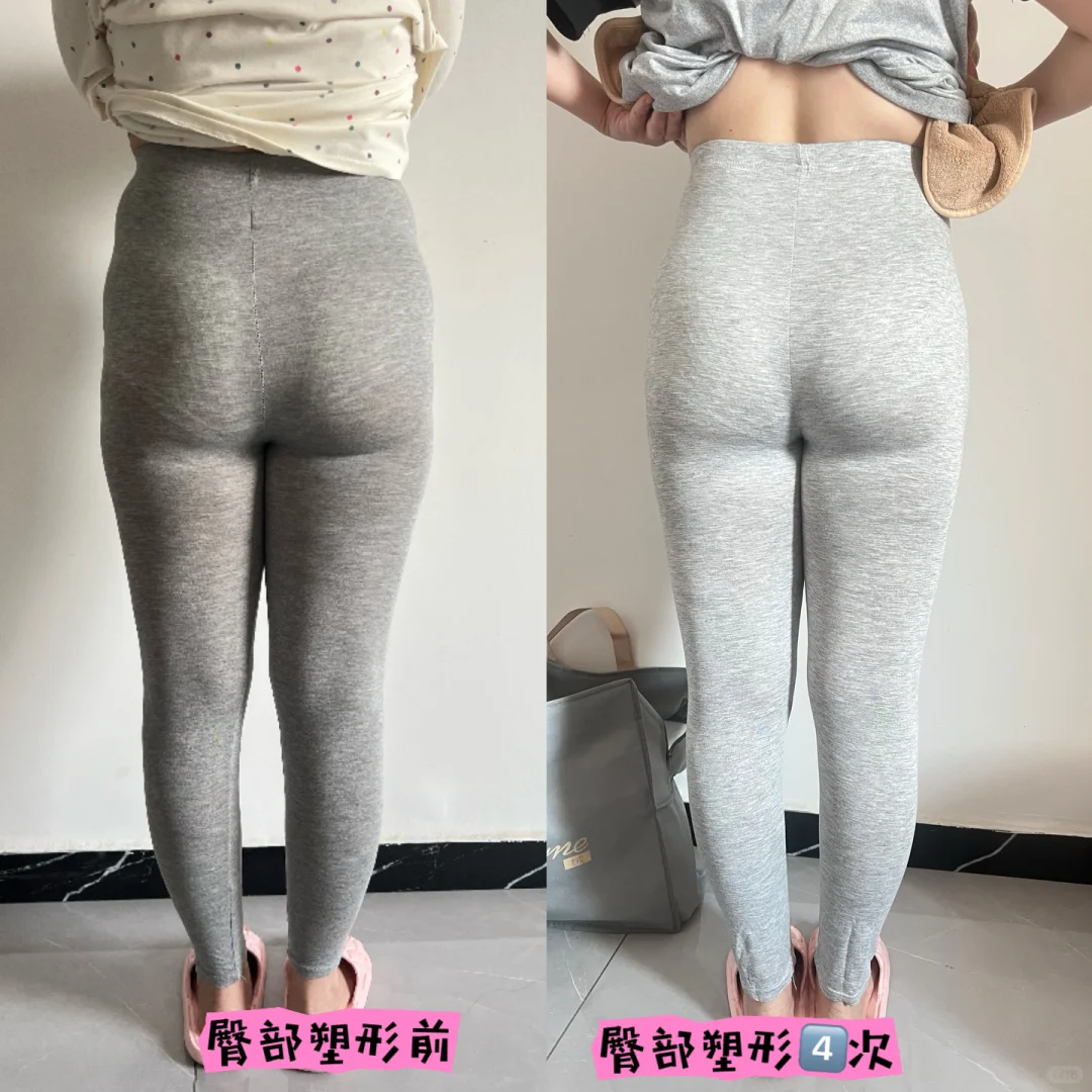 骨盆修复 | 重塑女性优雅，守护健康根基