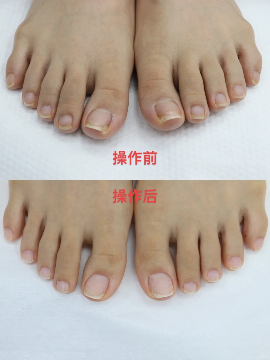 欧式美足操作前后对比