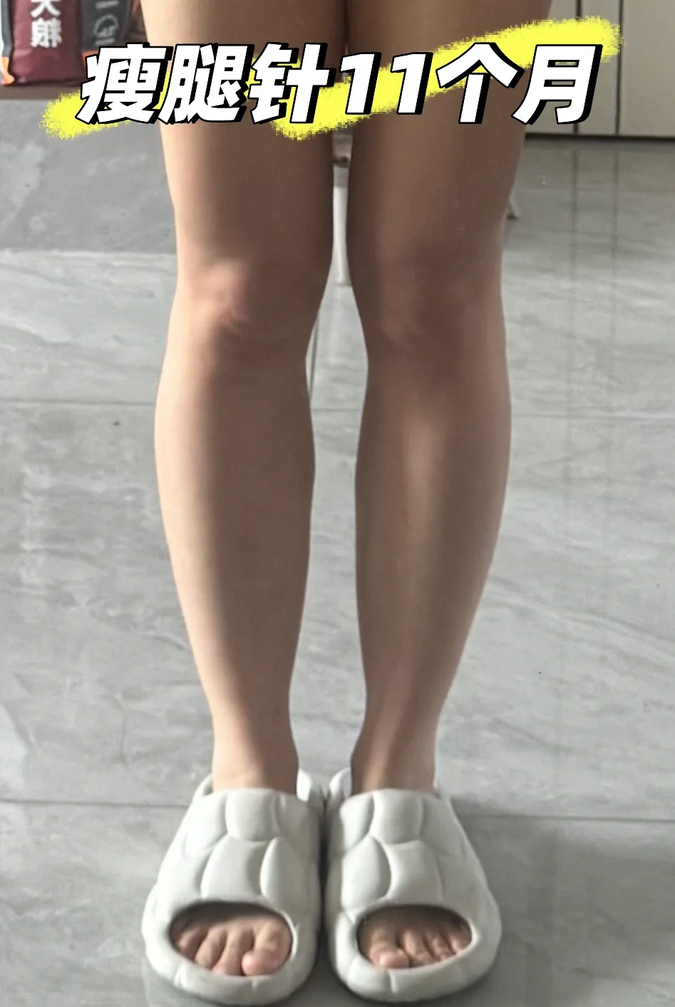 瘦腿针九个月后续，更新啦！！！