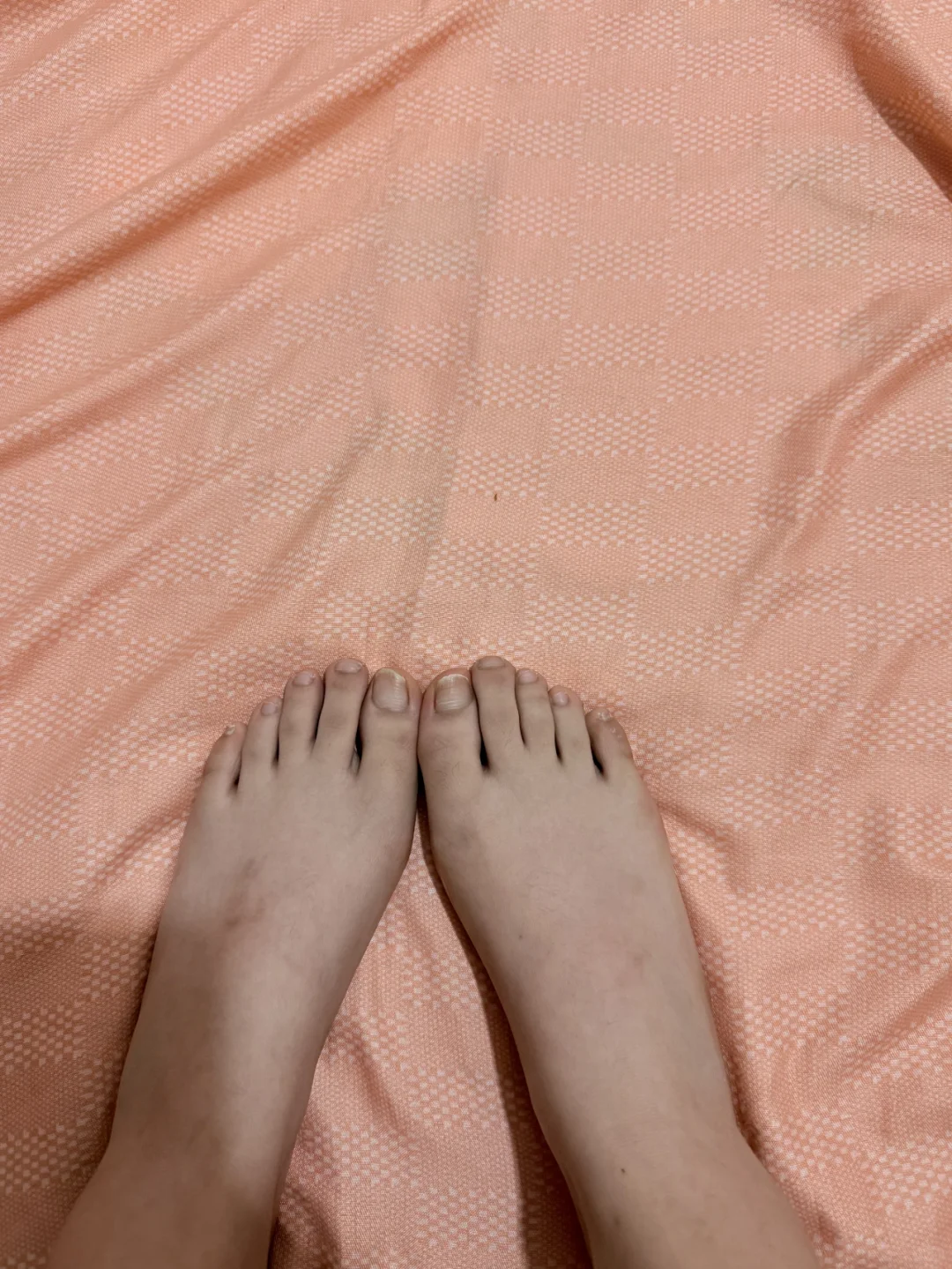 👣脚底白嫩，脚背好丑？拯救“阴阳脚”！