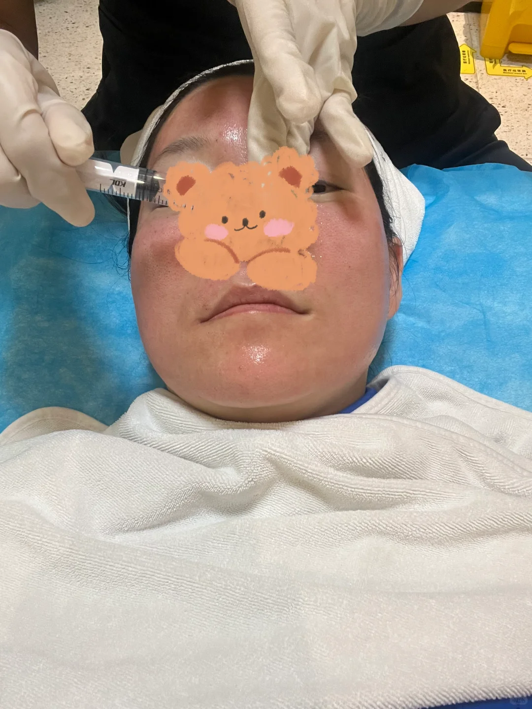 妈生脸首次做轻医美项目-黄金微针