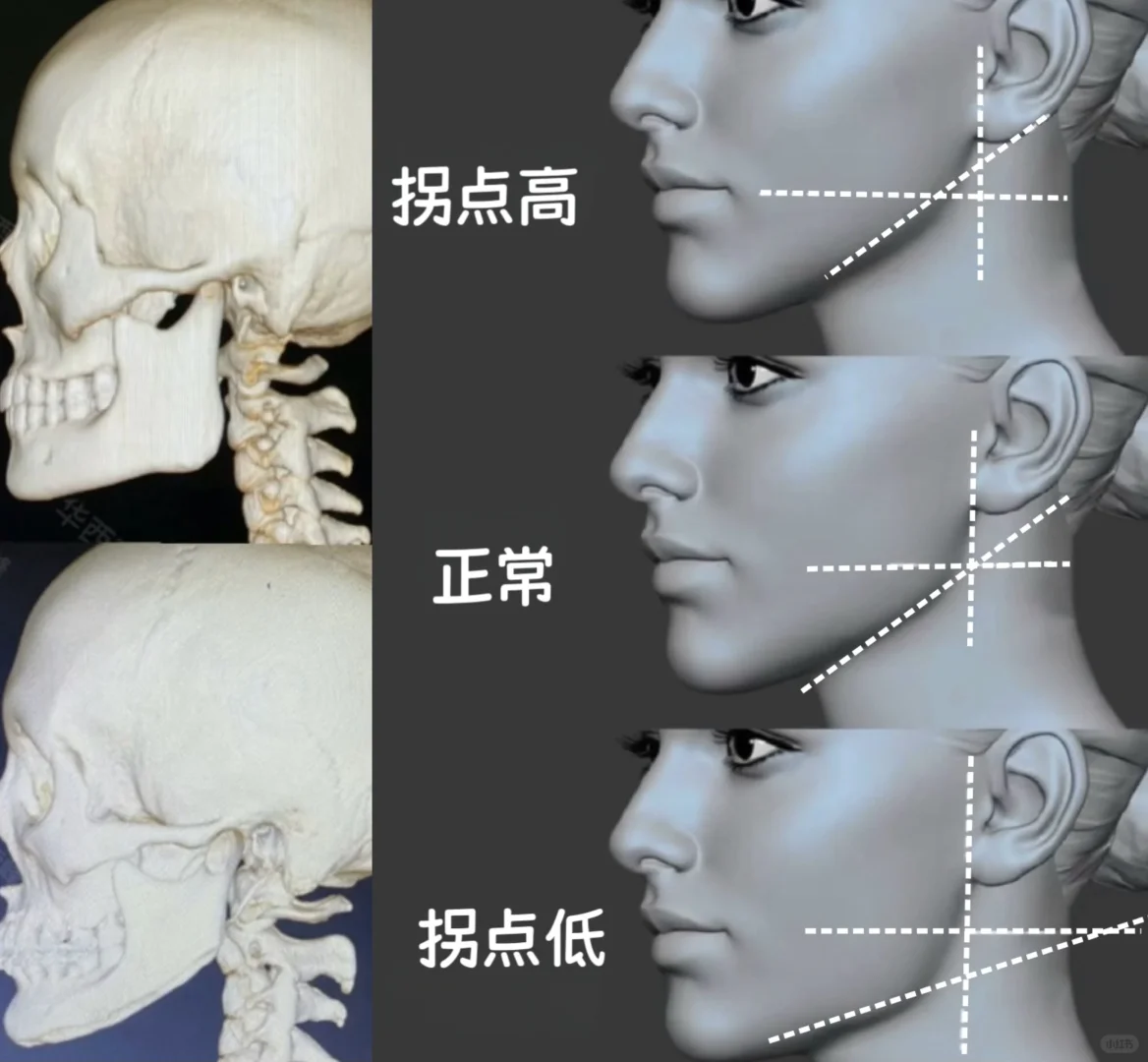 面部女性化功课分享——下颌角篇