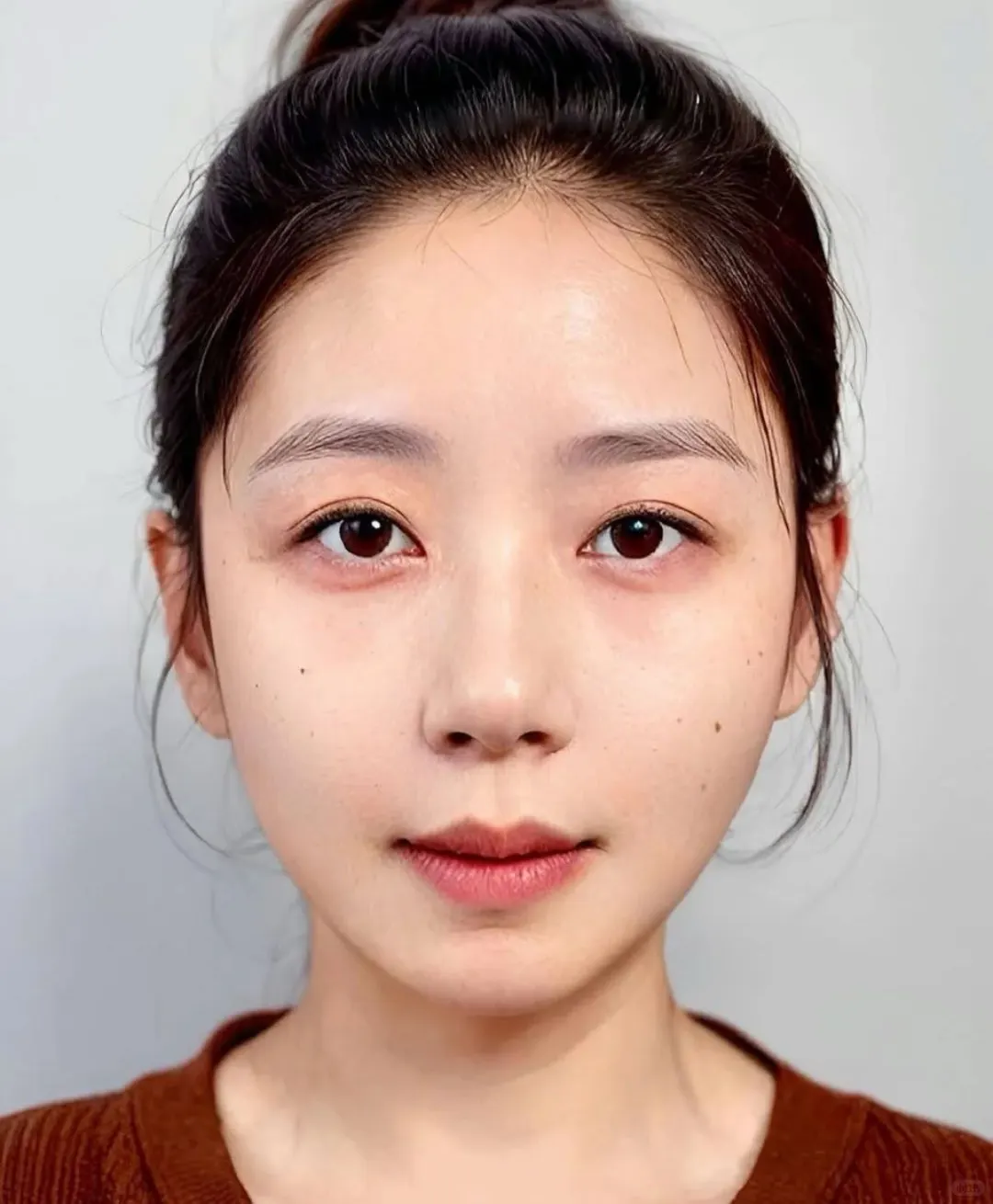 35岁脸凹凸不平，算是完美解决了吗